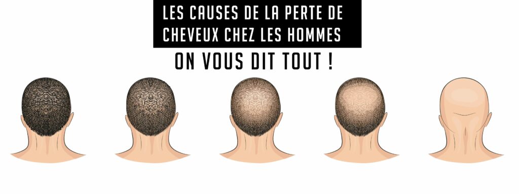 blog_chauve_calvitie_solution_complement_capillaire_remplacement2 compléments capillaires prothèses solution calvitie