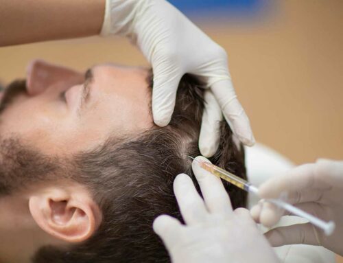 Plasma riche en plaquettes pour la perte de cheveux