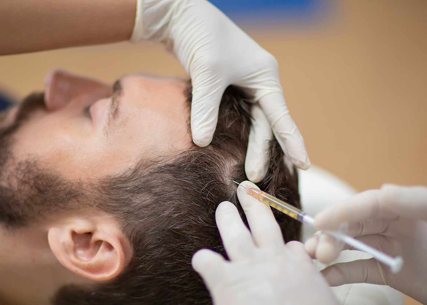 prp_plasma_contre_perte_cheveux