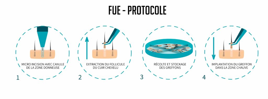 blog_greffe_fue_perte_cheveux_protocole fue greffe transplantation