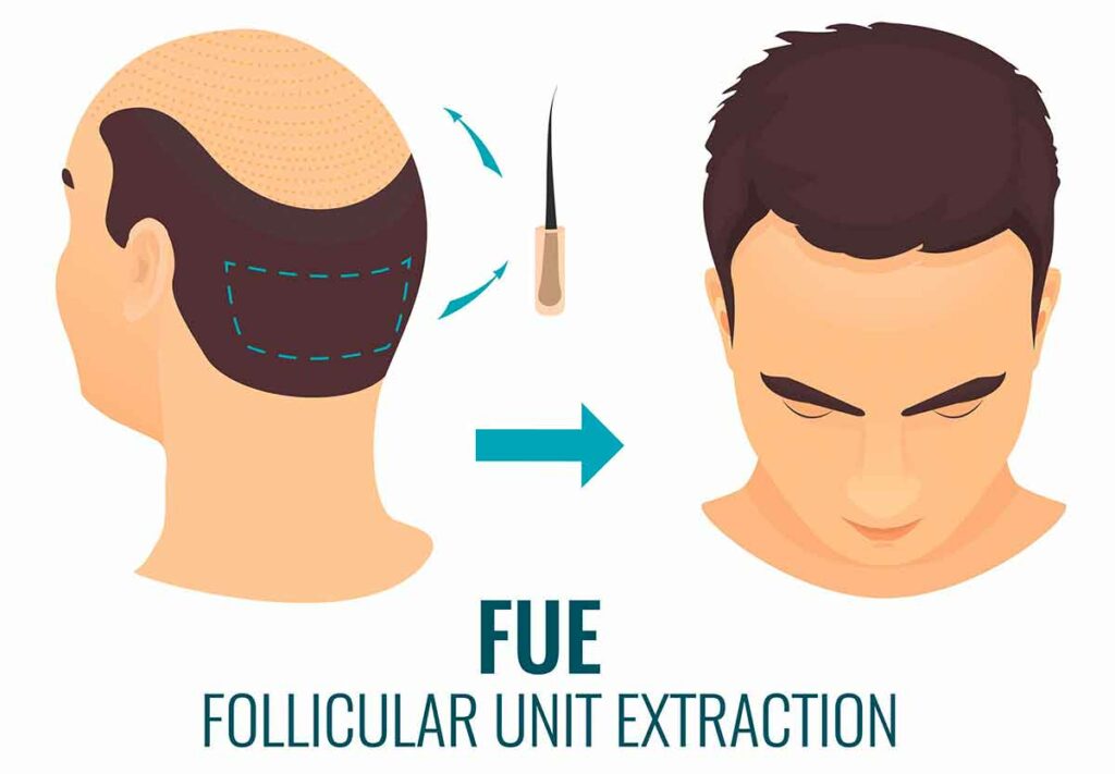 fue-micro-greffe fue micro greffe