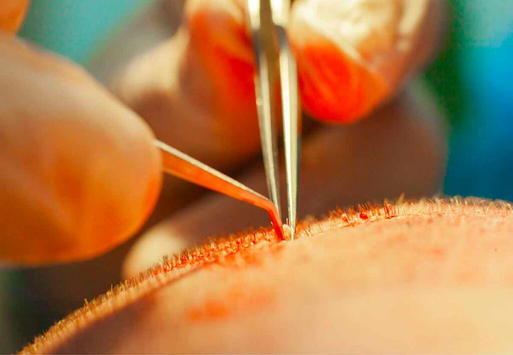 geffe_capillaire geffe capillaire transplantation greffons