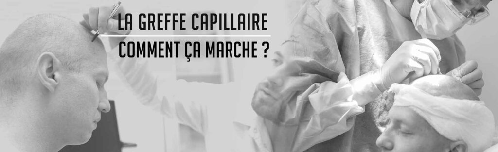 greffe_capillaire_deroulement_katsura greffe capillaire déroulement