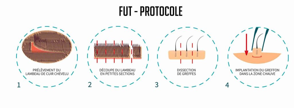greffe_fut_perte_cheveux_protocole greffe fut transplantation