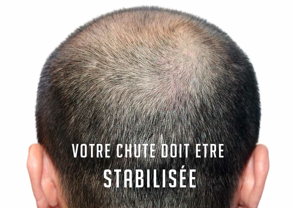 chute_cheveu_greffe_katsura chute de cheveux hommes calvitie