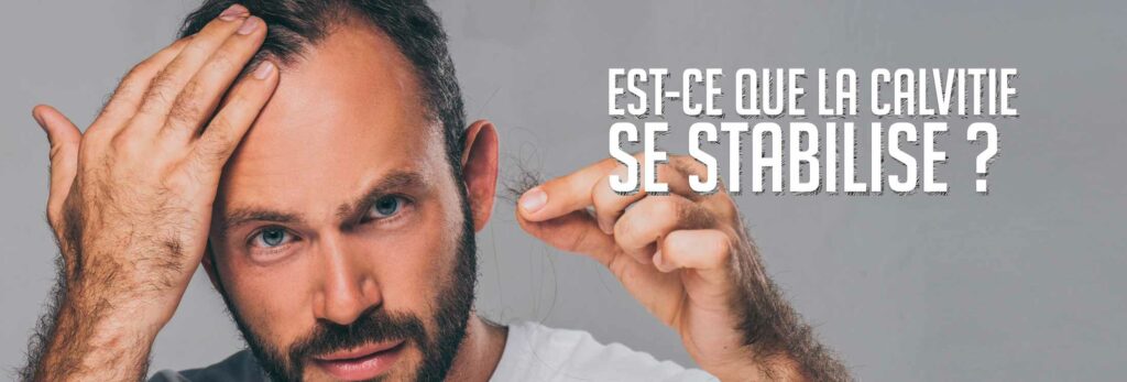 est_ce_que_la_calvitie_se_stabilise A quel âge la calvitie se stabilise