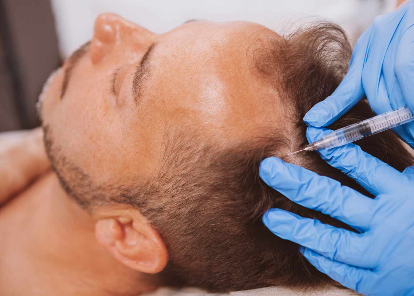 perte_cheveux_homme_injection_stimulation_repousse traitement injection stimulation pousse cheveux