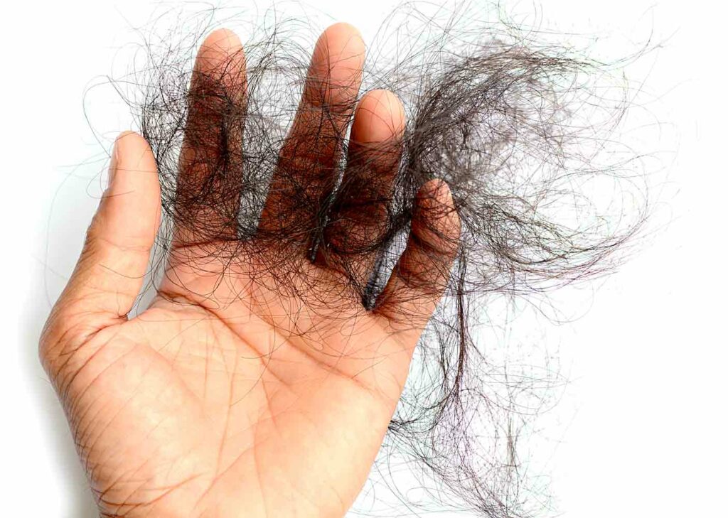 perte-cheveux-solution-minoxidil calvitie et pertes de cheveux